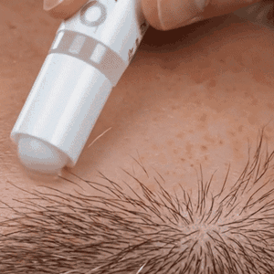 Application du sérum sur le cuir chevelu avec la bille